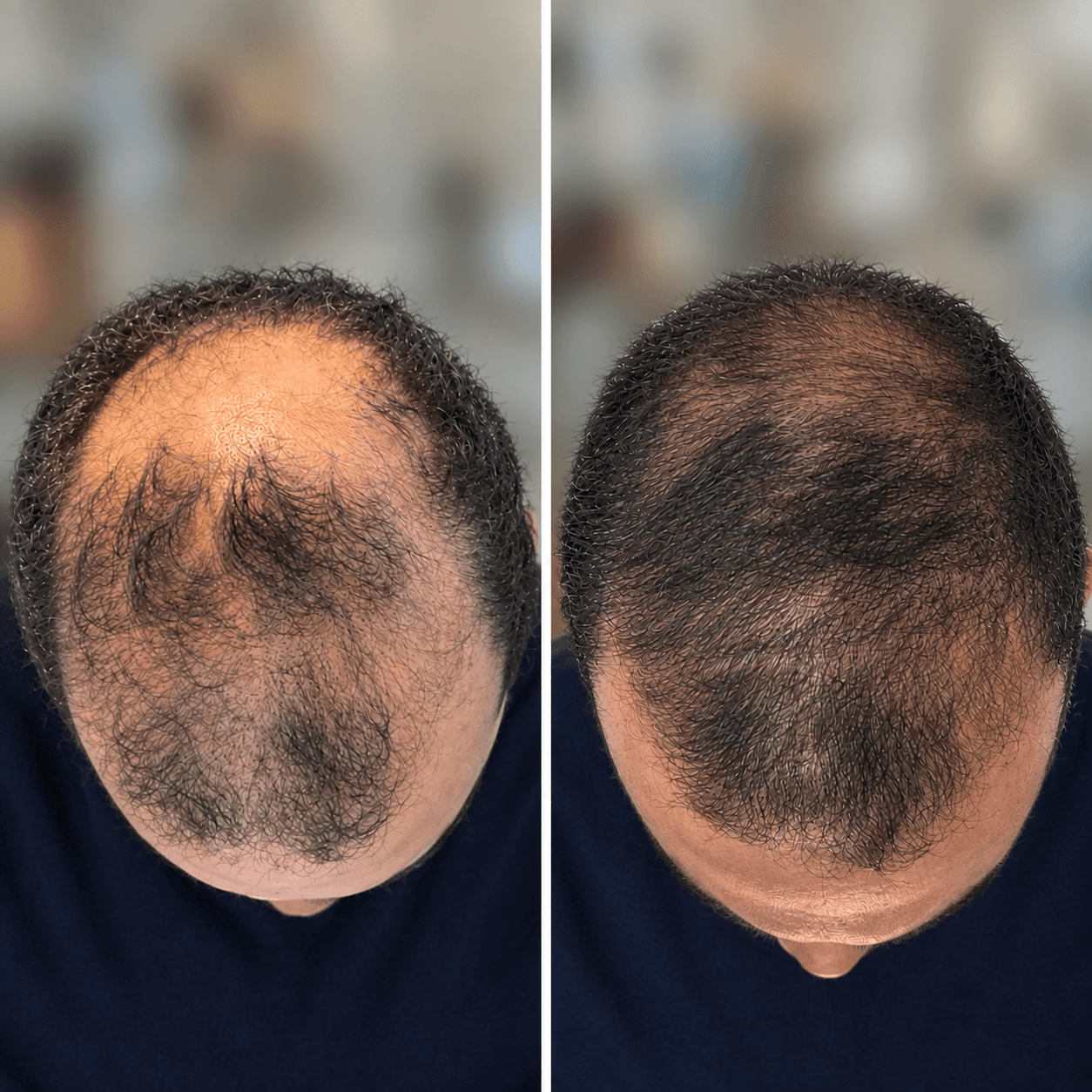 Top-down photos of the same scalp seventeen months apart, 17 months apart, showing visible regrowth across the crown and hairline